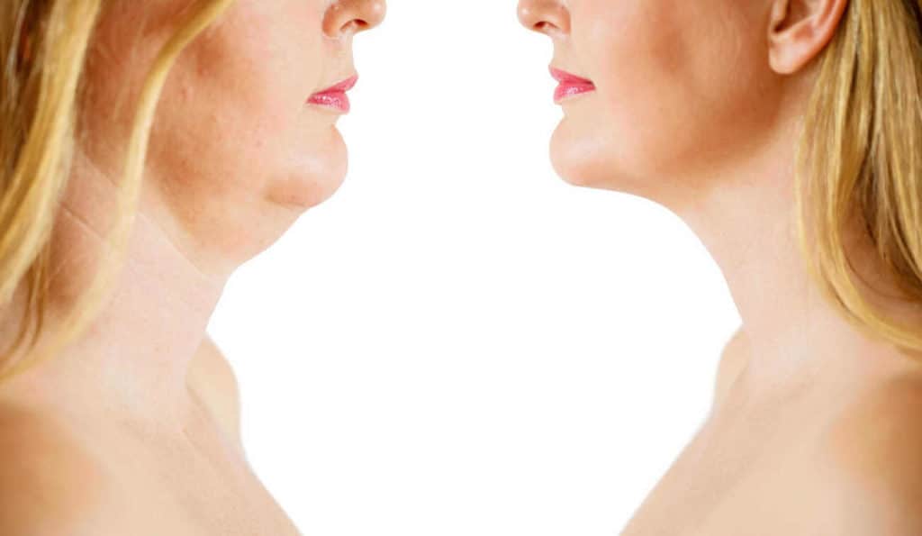Double Chin treatment Farthingstone before and after results