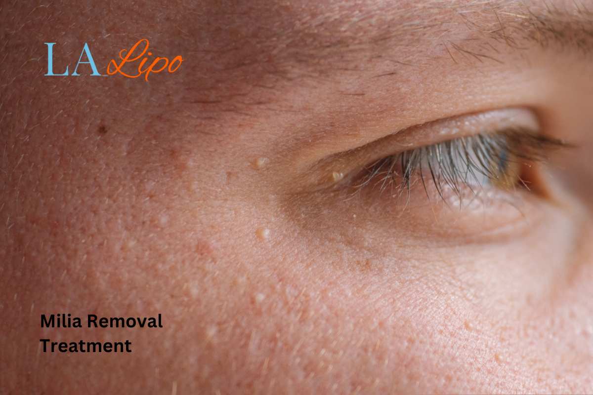 Cryopen Milia Removal: Is It the Easiest and Safest Option Farthingstone?