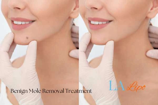 Before-and-after results following benign mole-removal treatment Farthingstone