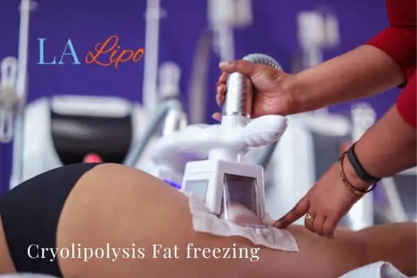 women getting fat freezing Farthingstone