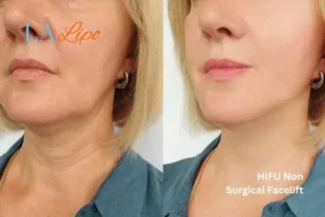 hi-fu for wrinkles Farthingstone before and after results