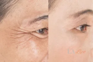 Before and after results of woman - HI-fu wrinkles reduction treatment Farthingstone
