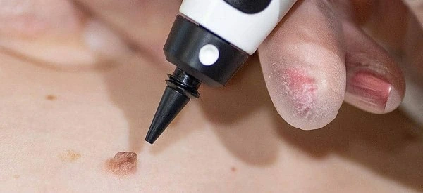 skin tag removal using cryopen Farthingstone