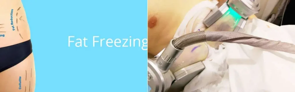 Fat freezing Farthingstone on multiple areas of the body