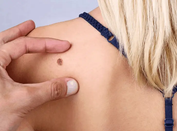 woman having mole removal Farthingstone consultation before treatment.