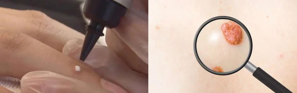 Cryopen for mole removal Farthingstone - speak to our team today!