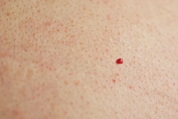 close up of a cherry angioma Farthingstone