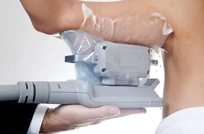 Picture of fat freezing Farthingstone on the upper arms.