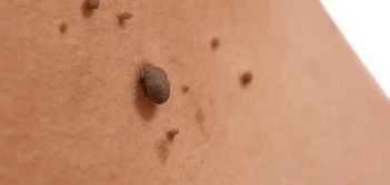 image of a skin tag Farthingstone