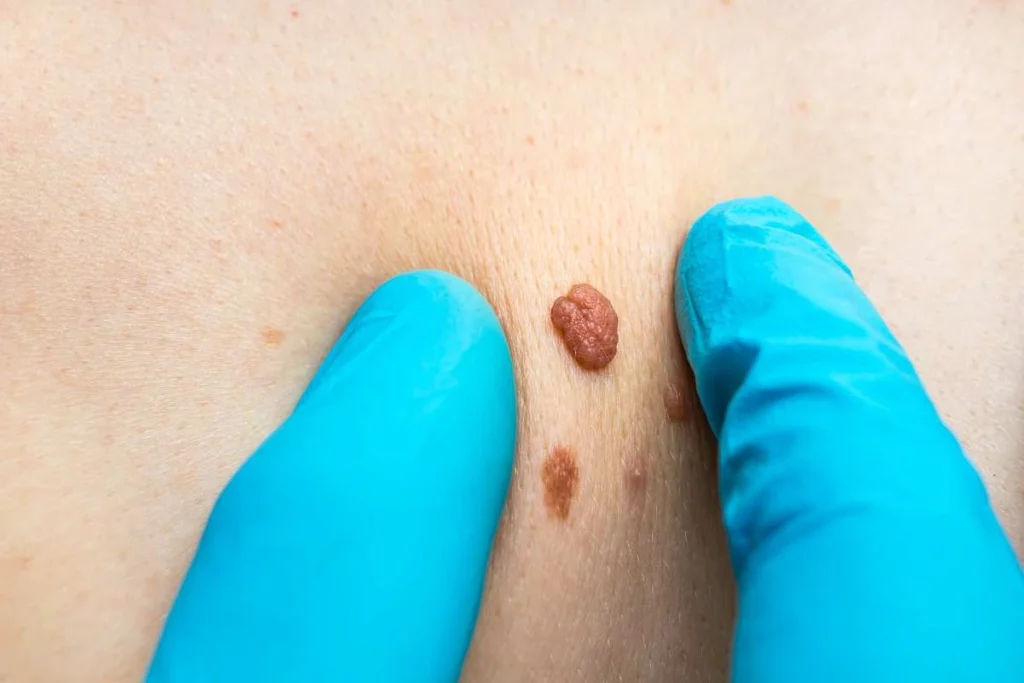 Consultant examining a skin tag Farthingstone