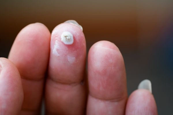 wart on person finger - cryotherapy to treat from LA LIPO Farthingstone