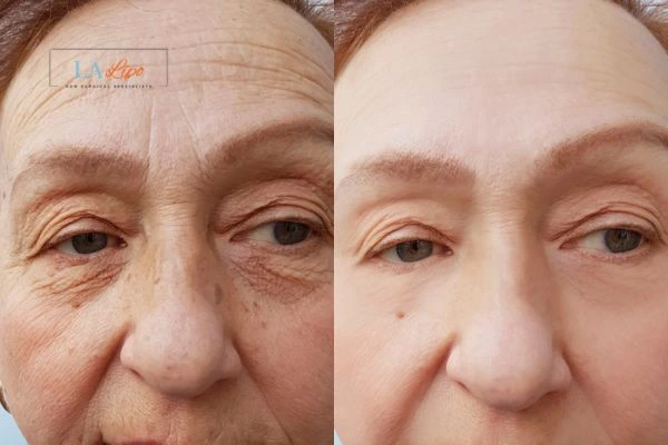 The powerful benefits of Morpheus8 Treatment Farthingstone - Call Our team today!