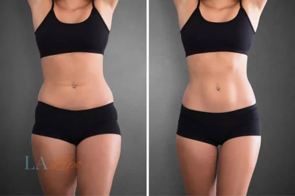 before and after results of non-surgical treatment to help a woman's body image and mental health Farthingstone