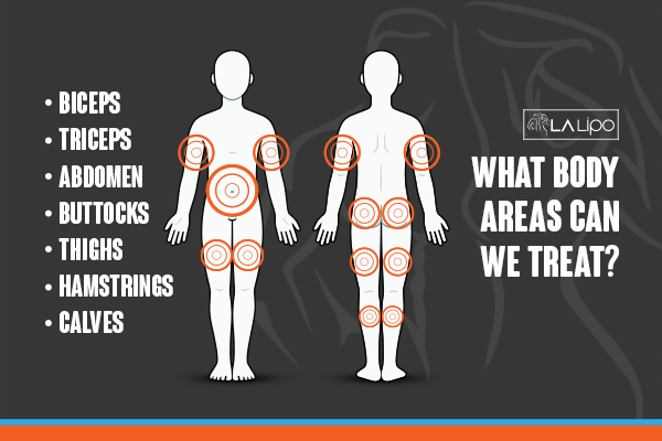 Diagram to show areas you can have LA-EMS Body Sculpting Treatment Farthingstone