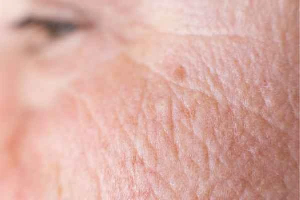 close up picture of a woman's face showing an age spot Farthingstone