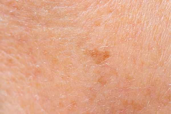 close up picture of age spots Farthingstone