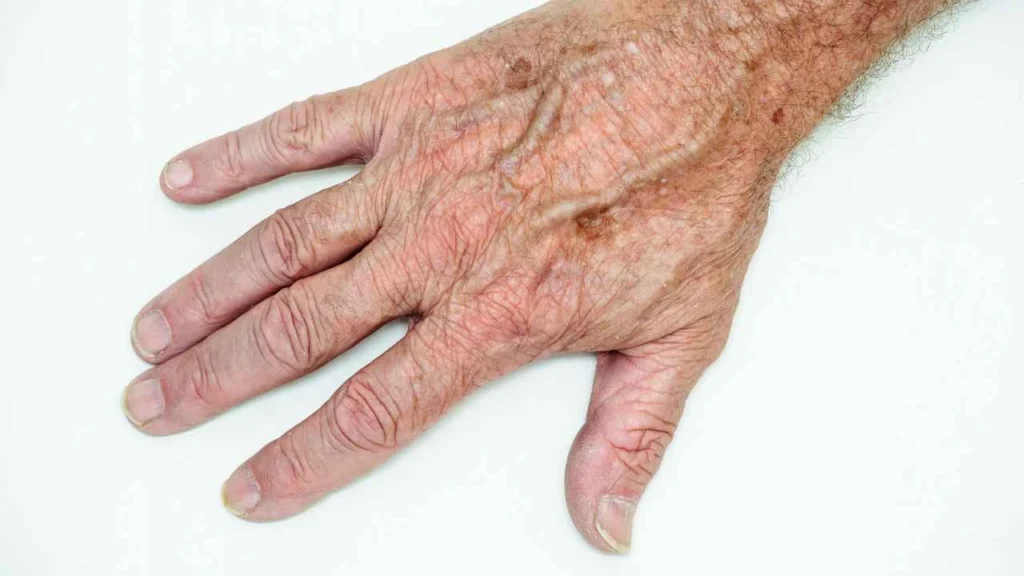 Male hand showing age spot Farthingstone