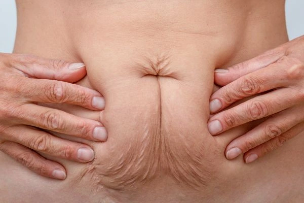 Should I Combine Diastasis Recti Treatment with Body Contouring for Better Results Farthingstone?