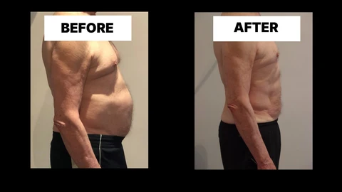 What Symptoms Can Diastasis Recti Cause in Men? Weak Core, Back Pain and Poor Posture Farthingstone